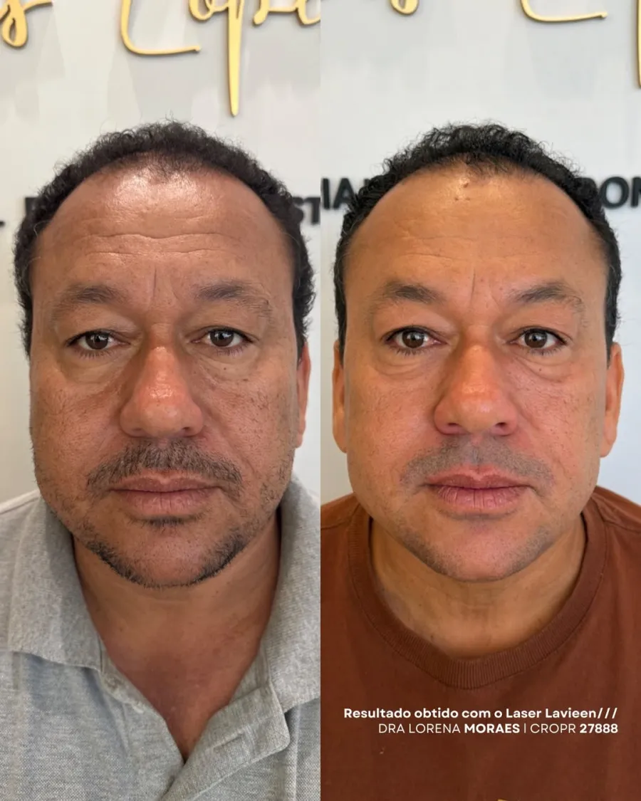 Botox 01 — Dra. Lorena Moraes