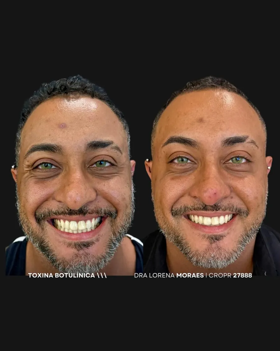 Botox 02 — Dra. Lorena Moraes