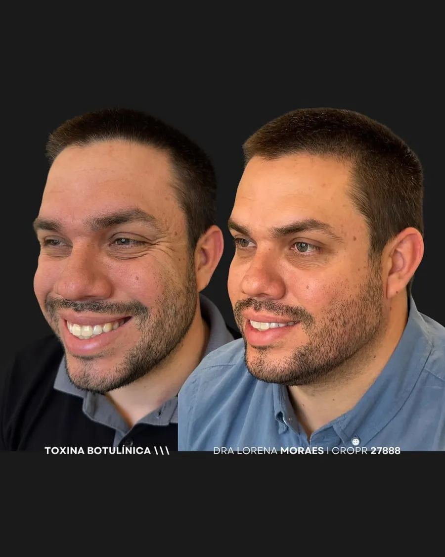 Botox 03 — Dra. Lorena Moraes