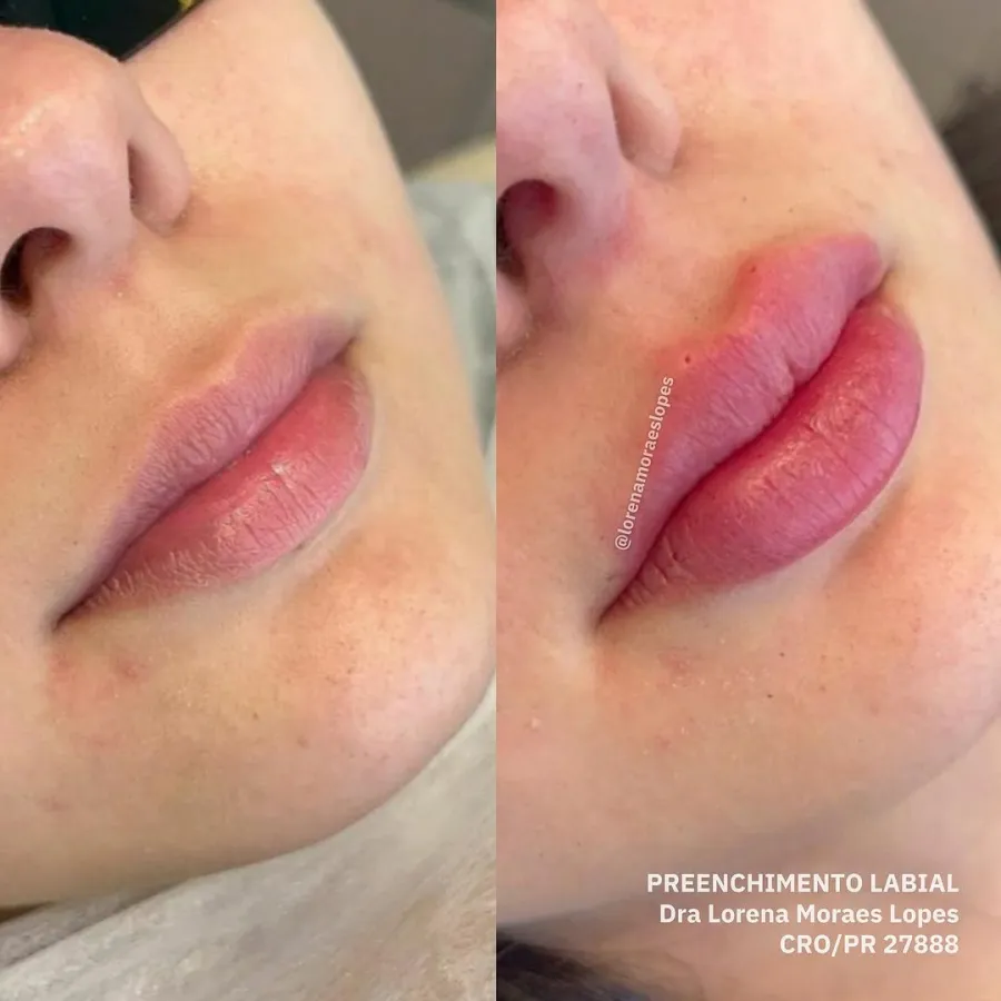 Preenchimento Labial 01 — Dra. Lorena Moraes
