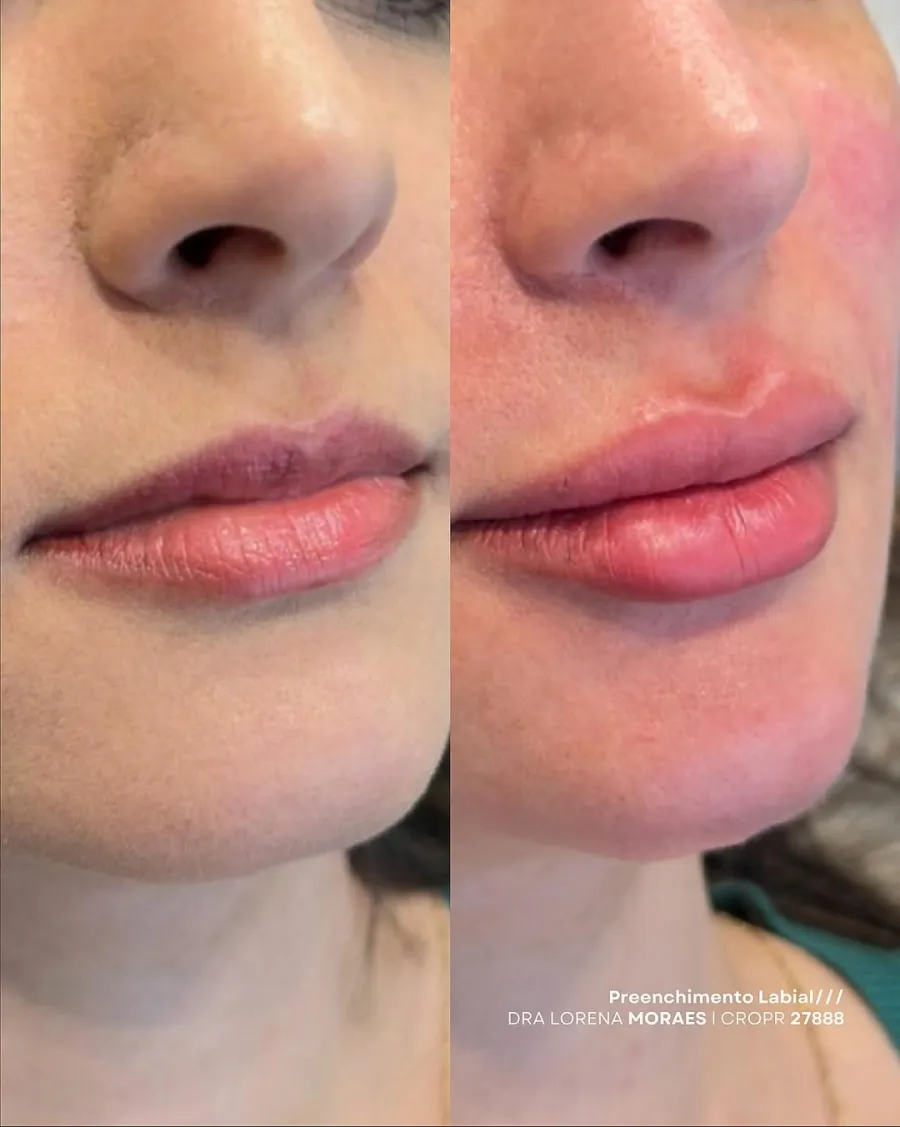 Preenchimento Labial 02 — Dra. Lorena Moraes