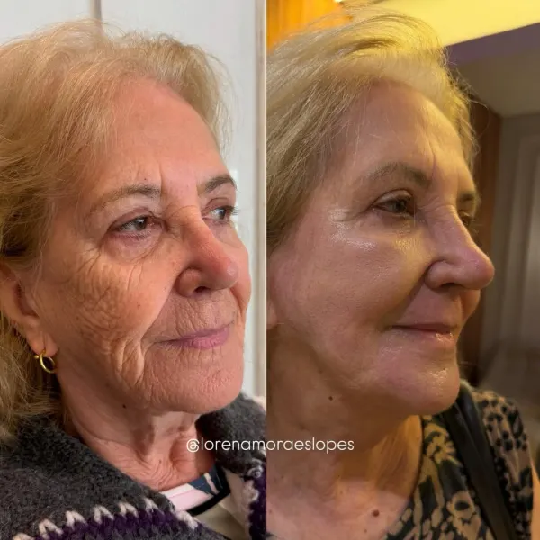 Resultado de Line Skin — Dra. Lorena Moraes