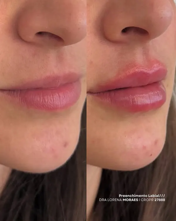 Resultado de Preenchimento Labial — Dra. Lorena Moraes