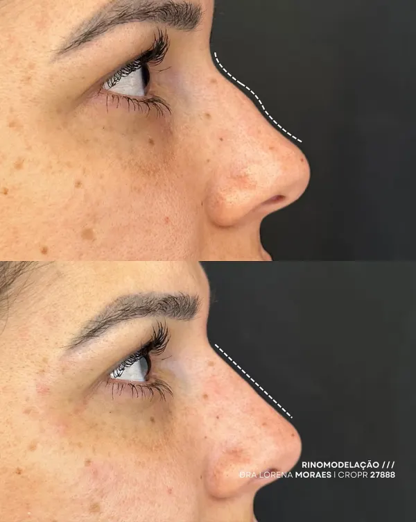 Resultado de Rinomodelação — Dra. Lorena Moraes